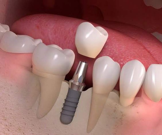 Коронка на зуб в Минске Ивалюс-Дент